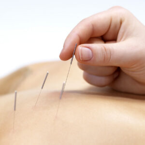 Acupuntura